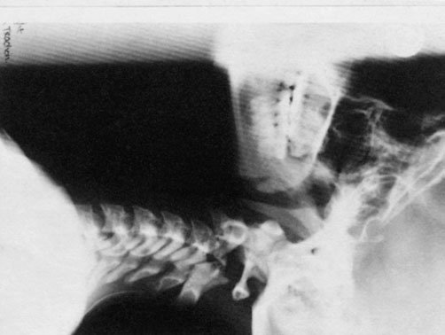 În radiografiile alăturate a fost inclusă o parte a craniului