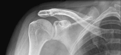 Radiografie antero-posterioară (AP), în decubit dorsal, a claviculei, evidențiind suspiciune de fractură