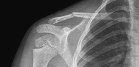 Radiografie antero-posterioară (AP), în decubit dorsal, a claviculei, evidențiind suspiciune de fractură patologică