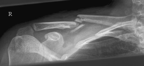 lezarea vaselor subclaviculare sau pneumotorax.