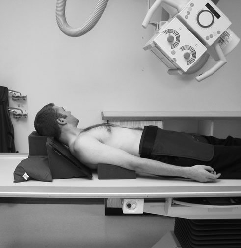 Radiografie infero-superioară (axială), în decubit dorsal, a claviculei, evidențiind vindecarea timpurie a [fragment deteriorat în sursă]