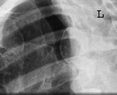 Radiografie a articulației sternoclaviculare drepte normale