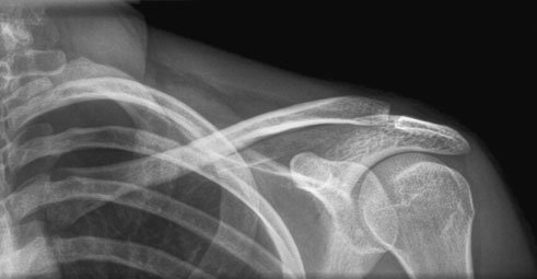Radiografie normală postero-anterioară (PA) a claviculei