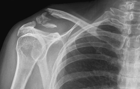Radiografie postero-anterioară (PA) a claviculei, evidențiind suspiciunea de fractură cominutivă