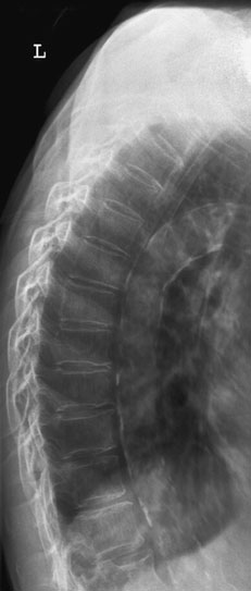 va reduce de obicei contrastul radiografic, demonstrând astfel