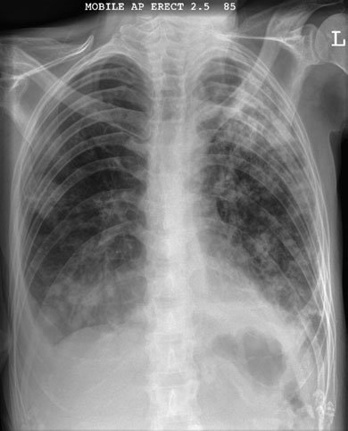 embolie pulmonară, pneumotorax și revărsat pleural (pleurezie) și pneu-
