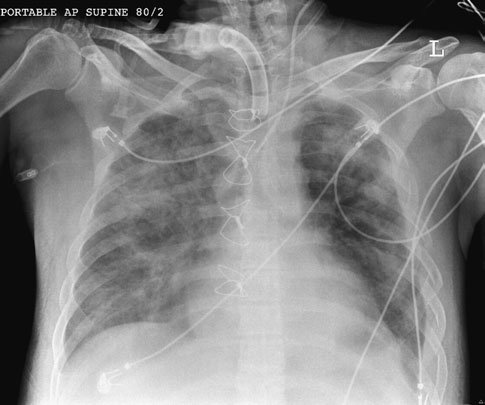 monie. Radiografia toracică postoperatorie este, de asemenea, frecvent necesară.