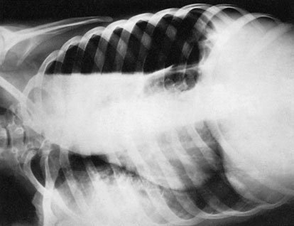 Radiografie postero-anterioară (PA) în decubit lateral care evidențiază aspectul pleural
