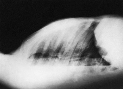 Radiografie de profil în decubit dorsal care evidențiază revărsat pleural (pleurezie).