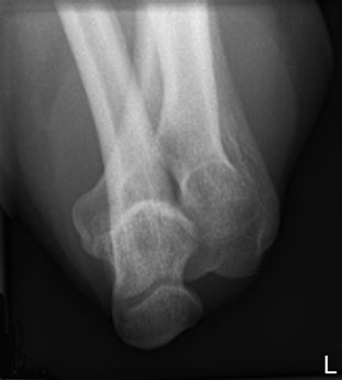 Radiografie axială de cot – braț în aparat gipsat, cu brațul superior în