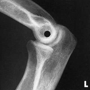 Radiografie de profil a cotului pentru capul radial –