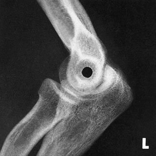 Radiografie de profil a cotului pentru capul radial –