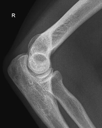 Radiografie de profil a cotului