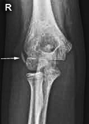 Radiografie de profil a cotului evidențiind elevarea perniței adipoase anterioare și