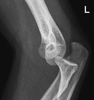 • Fractura suspectă a capului radial poate fi aproape sau complet ocultă,