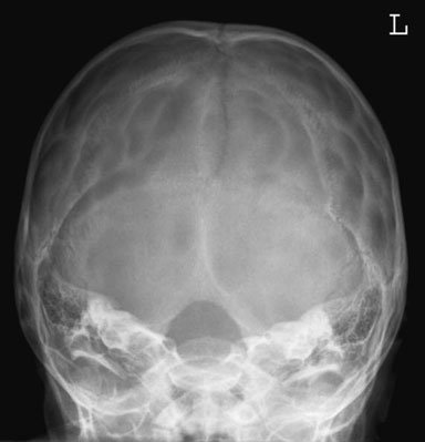 Imagine de radiografie craniană fronto-occipitală subînclinată, utilizând o pernă de 15 grade