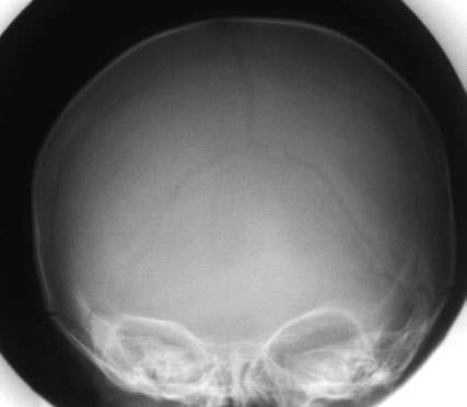 Diagramă frontală a craniului, evidențiind colimarea fasciculului luminos