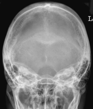 Figura 5: Aspect radiografic / Poziționare (Clark Ed. 12)