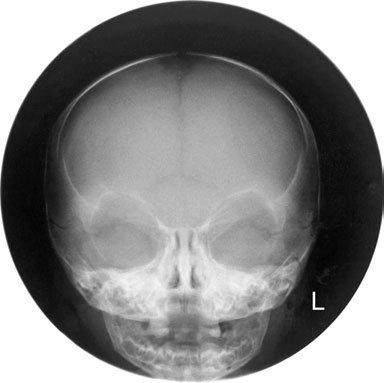 Imagine de radiografie craniană fronto-occipitală normală