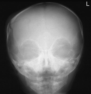 Imagine de radiografie craniană fronto-occipitală a unui sugar, evidențiind partea dreaptă