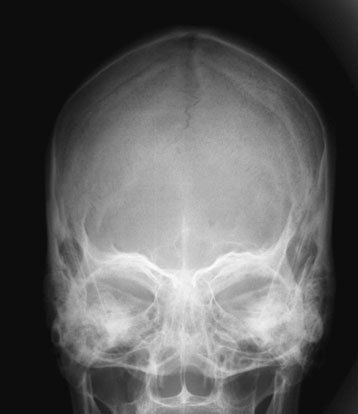 Figura 5: Aspect radiografic / Poziționare (Clark Ed. 12)