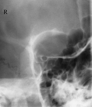 Figura 3: Aspect radiografic / Poziționare (Clark Ed. 12)