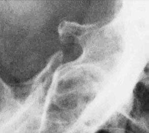 poate fi obținută prin radiografie simplă. planșeu dublu al