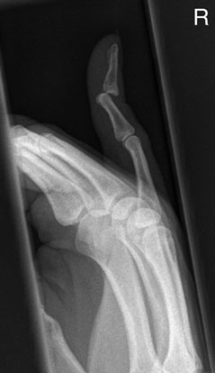 Radiografie de profil (laterală) a