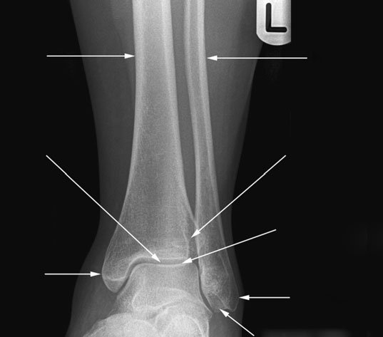 Radiografie antero-posterioară (AP) adnotată