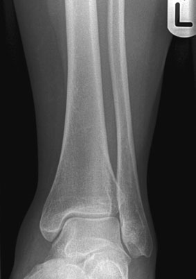 Radiografie antero-posterioară (AP) normală a