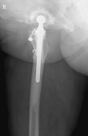 deoarece poate ascunde leziunea. La radiografiile de urmărire ulterioare,