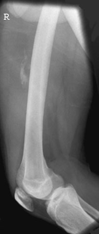 Radiografie a femurului, în incidență de profil, cu șoldul în jos,