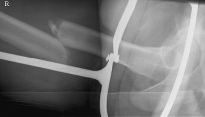 Radiografie a femurului, în incidență de profil,