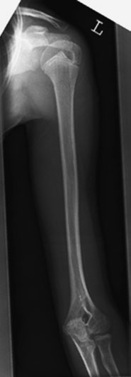 radiografie a humerusului