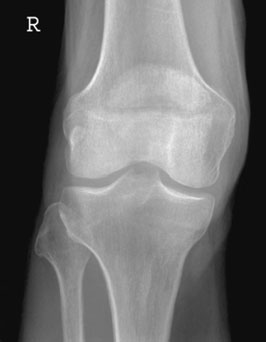sau al suspiciunii de fractură a platoului tibial. Lipohemartroza apare atunci când o