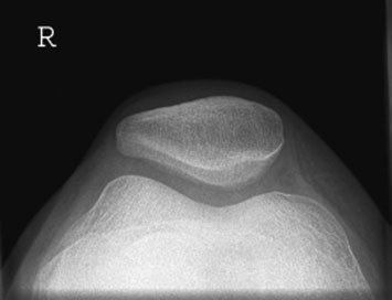 Radiografie infero-superioară (axială) cu flexie insuficientă, care determină proiectarea tibiei