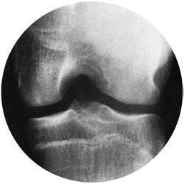 radiografie a incizurii intercondiliene evidențiind un corp liber