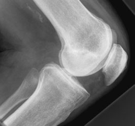 Radiografie de profil a genunchiului cu