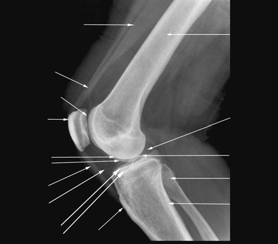 Radiografie de profil a genunchiului cu flexie de 45 grade