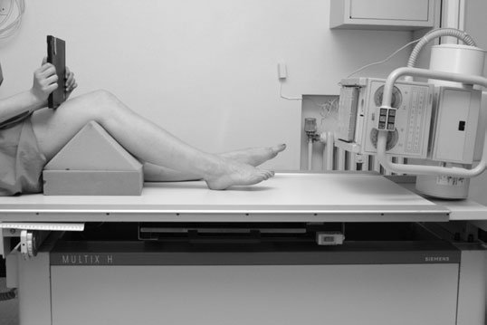 Incidență axială inferosuperioară convențională care evidențiază osteofitoză
