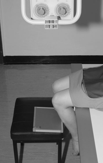 Imagine superoinferioară care evidențiază unele modificări degenerative și un fragment liber