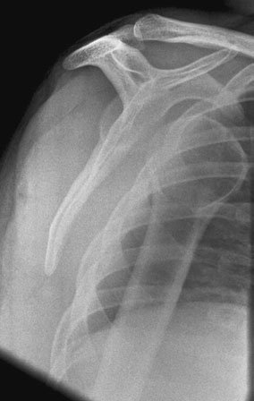 Radiografie oblică de umăr în incidență de profil, evidențiind luxația articulară anterioară