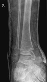 la acei pacienți cu suspiciune clinică de fractură și aparat gipsat sub genunchi