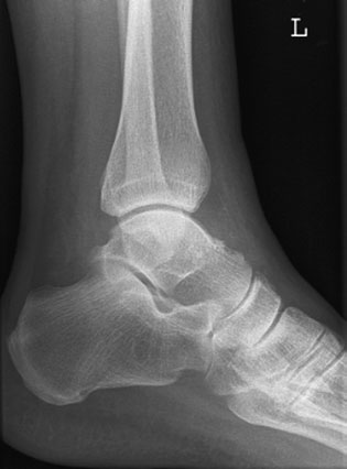 • Ruptura ligamentelor colaterale fără suspiciune de fractură osoasă poate