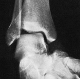 Figura 3: Aspect radiografic / Poziționare (Clark Ed. 12)