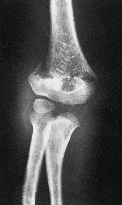 Radiografie anteroposterioară (AP) în