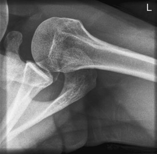 Radiografie axială a umărului evidențiind luxație posterioară