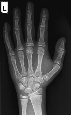 Radiografie postero-anterioară (PA) normală a mâinii stângi