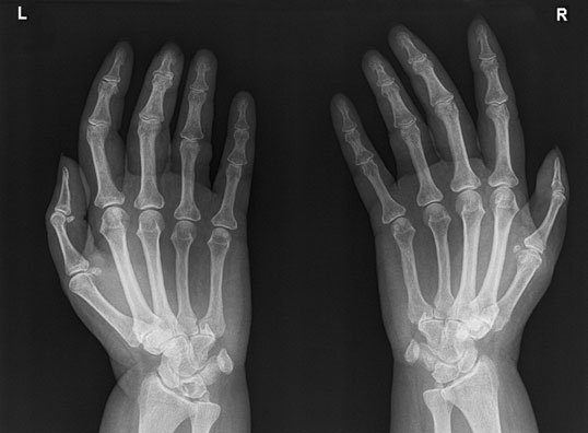 Radiografie normală a mâinilor în poziția prin metoda incidenței Norgaard (prinderea mingii)