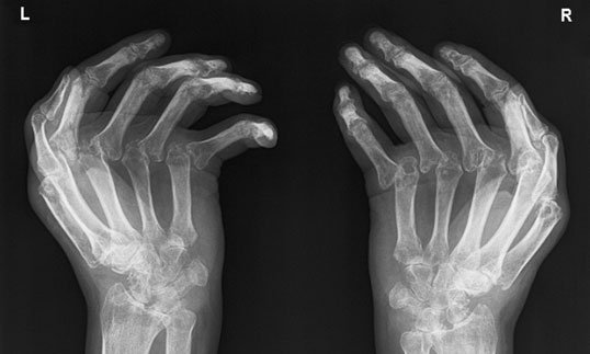 Radiografie a mâinilor în poziția prin metoda incidenței Norgaard (prinderea mingii), evidențiind boală erozivă severă